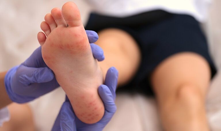 fascitis plantar en niños