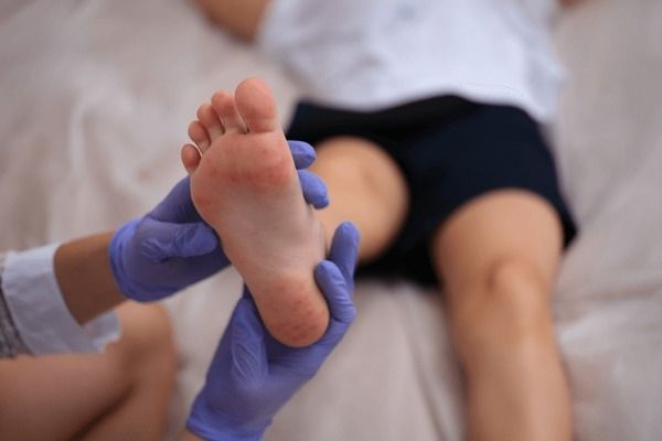 consultar al médico por los pies hinchados en niños