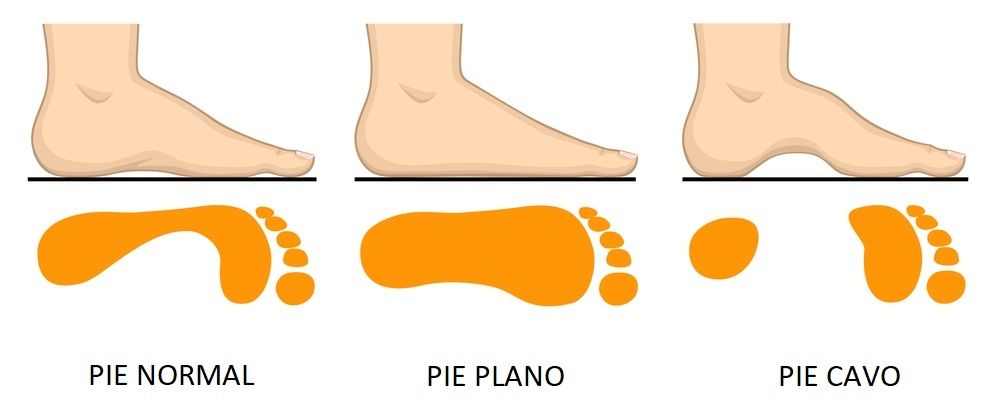 pies planos niños